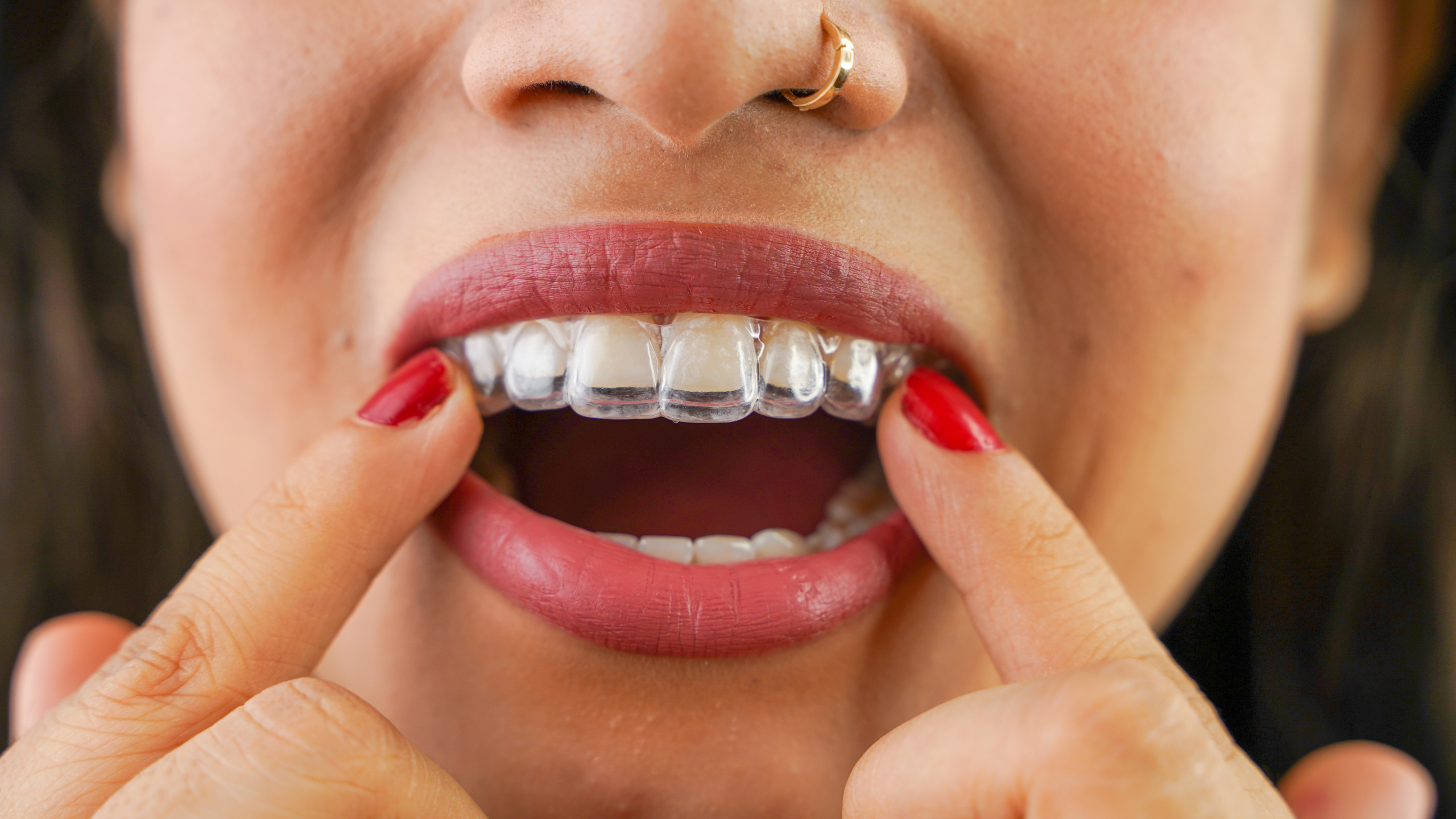 Clear Aligners & Invisalign